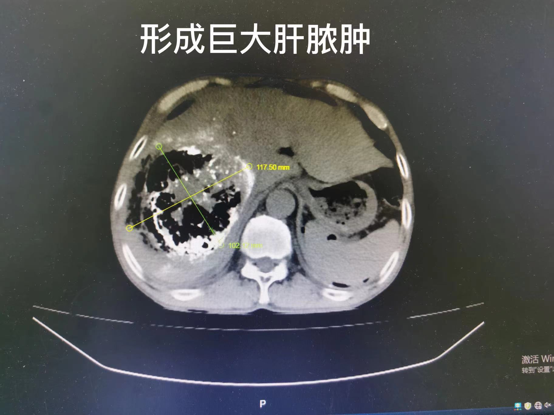 综合微创介入治疗，让恶性肝肿瘤患者绝处逢生(图4)