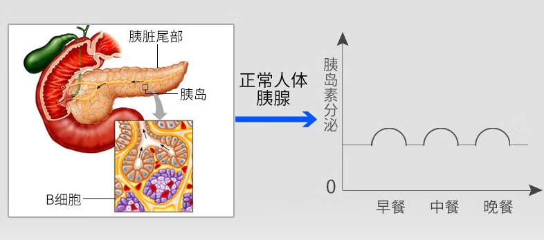 区域内首家|我院常规开展胰岛素泵强化治疗(图2)