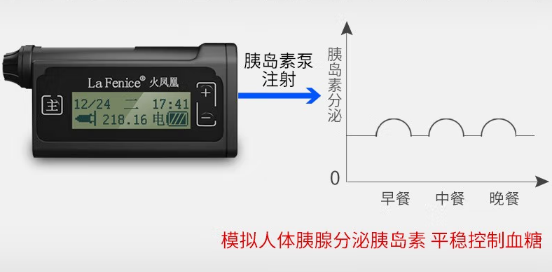区域内首家|我院常规开展胰岛素泵强化治疗(图3)