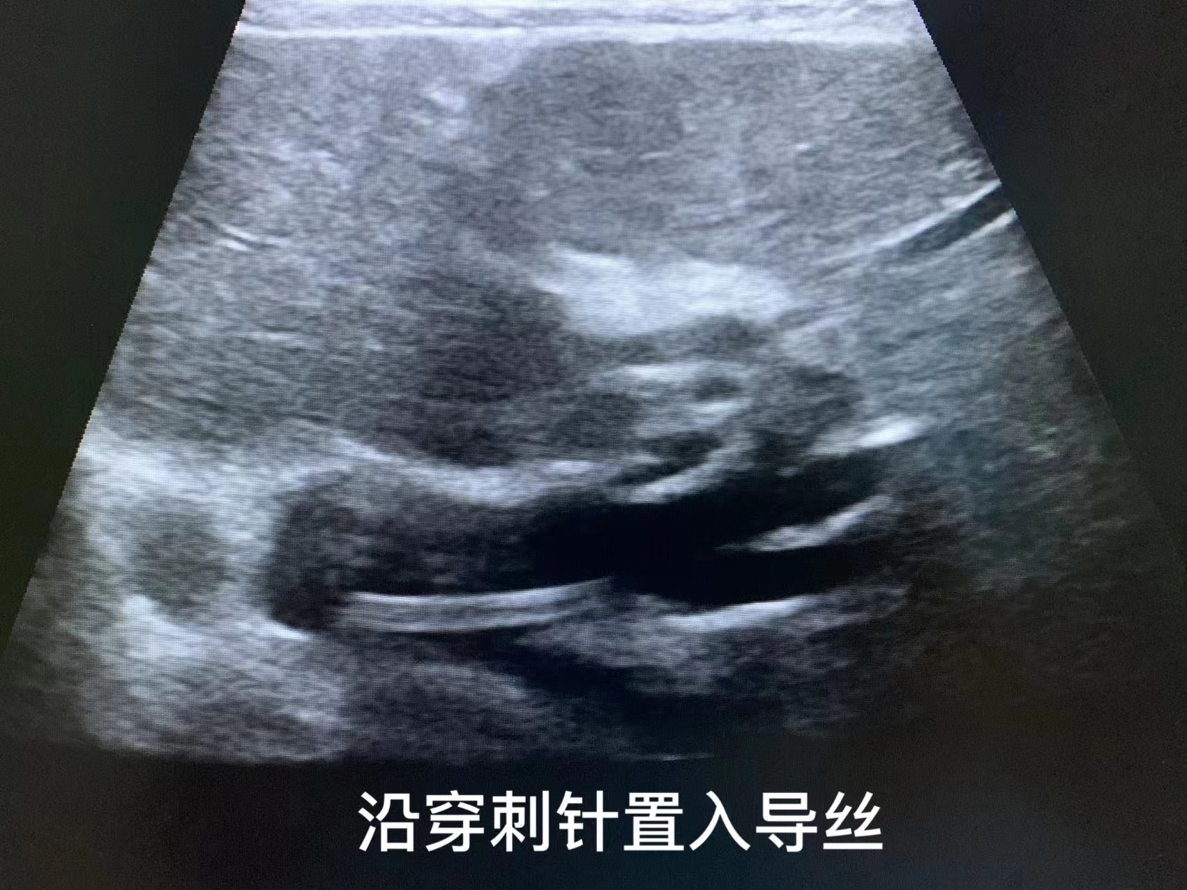 超声引导、精准定位，超声引导下PTCD术挽救、延长患者生命(图2)