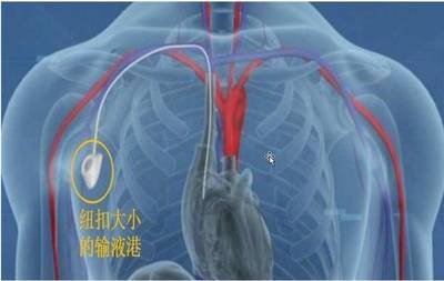 输液“神器”-输液港，最温柔的打针方式(图1)