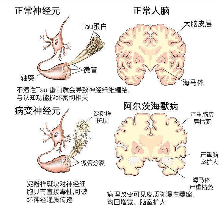转个身就忘事？老年痴呆10大预警信号自测！(图3)