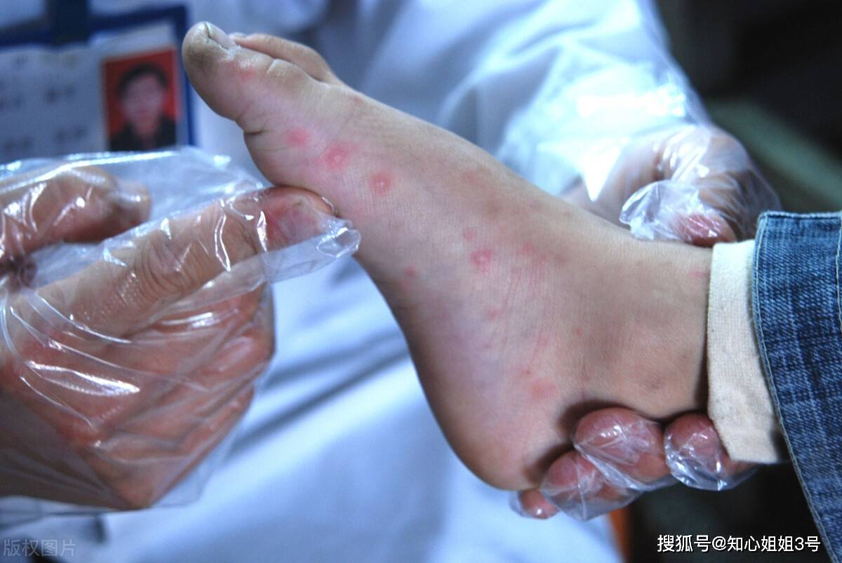 手足口病即将来袭！儿科医生教你如何预防手足口！(图2)