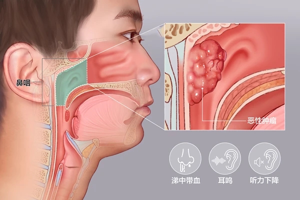 鼻咽癌来临前几大征兆，早知道就是救命(图1)