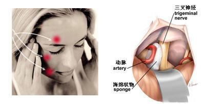 医学科普 | 有种撕心裂肺的痛叫三叉神经痛(图3)
