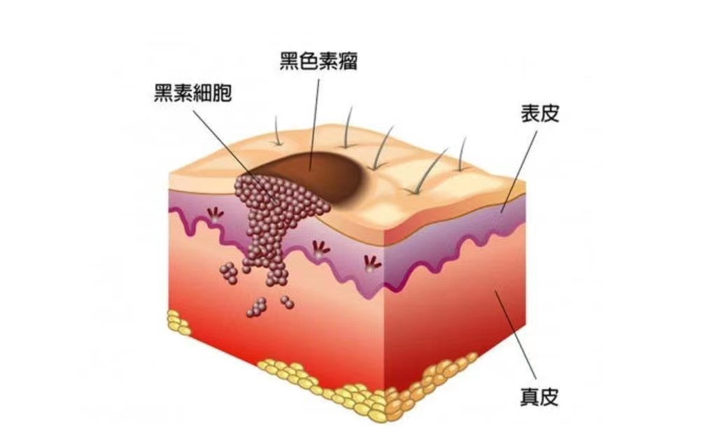 三分钟了解黑色素肿瘤，教你识别“好痣”与“坏痣”(图2)