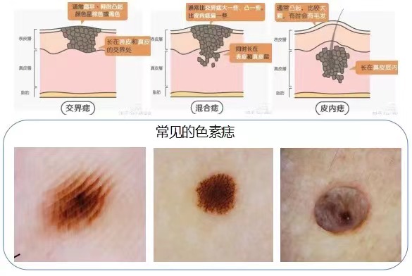 三分钟了解黑色素肿瘤，教你识别“好痣”与“坏痣”(图3)