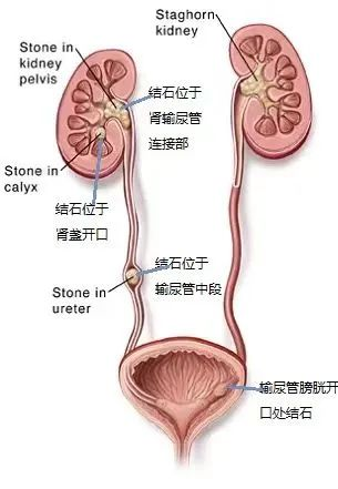 让人痛彻心扉的小石头，该拿它怎么办？(图1)