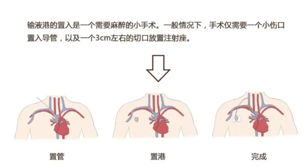 不再为“生命港口”跋涉，解决患者“后护之忧”(图1)