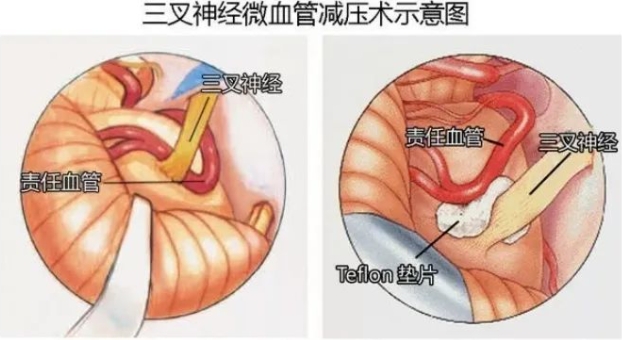 牙疼久治不愈、脸抽筋，你真的看对病了吗! ? 微血管减压术“一招制敌”！(图3)