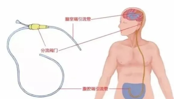 我院神经外科、普外科共同完成腹腔镜辅助下脑室-腹腔分流术！(图2)