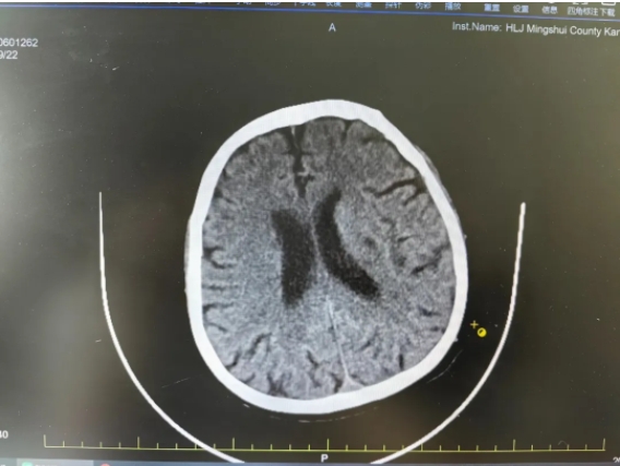 脑梗死来袭有前兆，早期识别很重要！(图2)