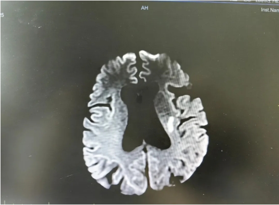 脑梗死来袭有前兆，早期识别很重要！(图3)