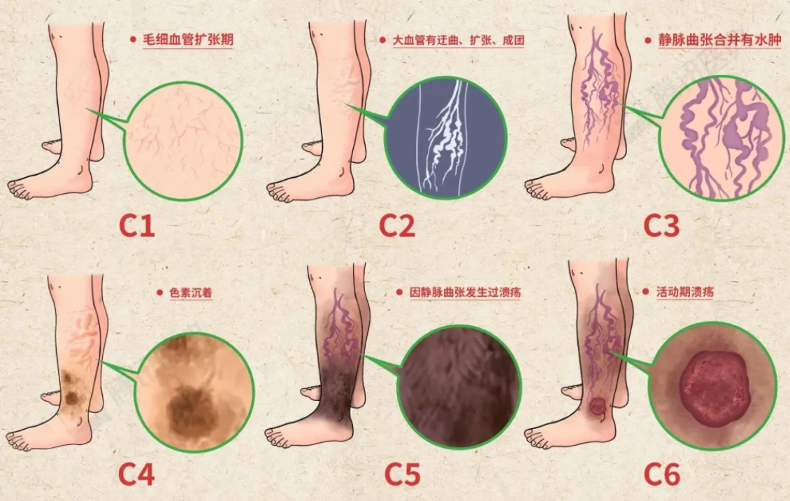 红血丝,青筋凸起......腿上出现这些症状,一定要警惕！(图2)
